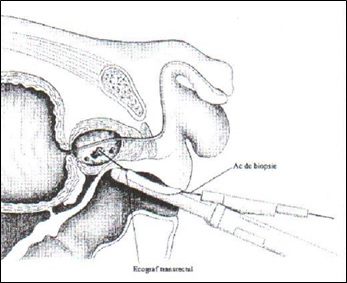 punctie biopsie prostatica